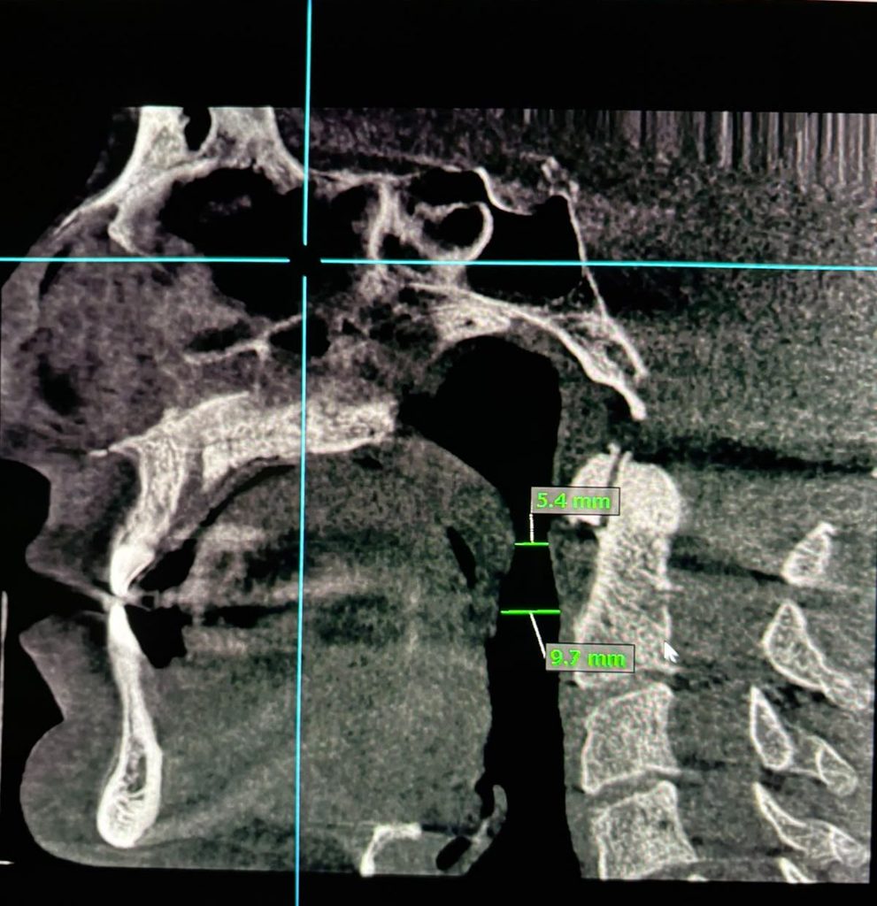 CBCT imaging shows where your airway narrows.