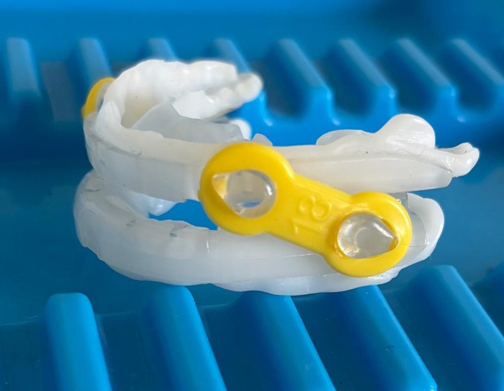 Clear oral appliance with yellow connectors that holds the lower jaw forward to keep the airway open during sleep